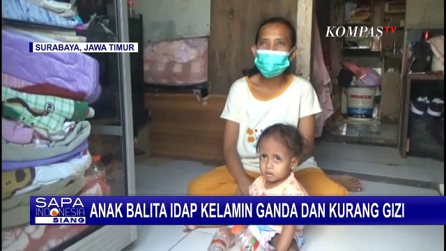 Balita Idap Kelamin Ganda dan Kurang Gizi, Orangtua Berharap Segera Dapat Penanganan Medis