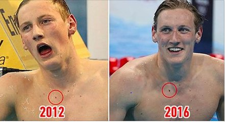 Mack Horton : un fan lui permet d'éviter un cancer de la peau