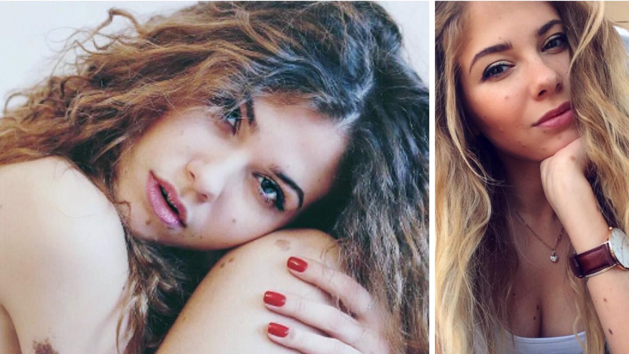 Yulianna Yussef : atteinte d'un naevus géant congénital, les médecins la disaient condamnée à sa naissance. Aujourd'hui, elle prend la plus belle des revanches