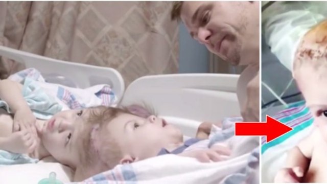Ces bébés siamois ne pouvaient être indépendants l'un de l'autre... Les voici après l'opération !