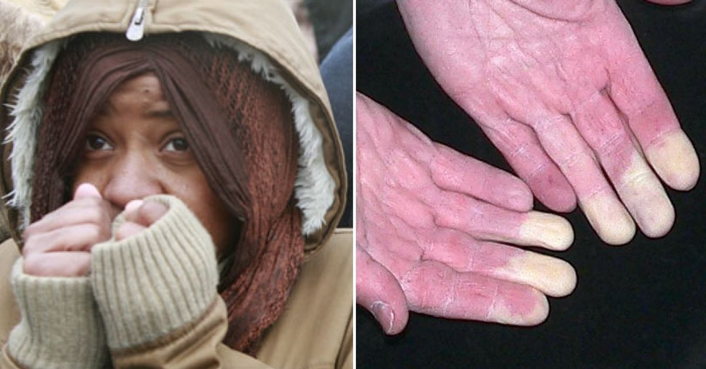 La maladie de Raynaud, cette maladie qui provoque des douleurs aux mains à cause du froid