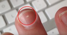 Santé : si vous avez ces petites tâches blanches sur vos ongles, voici la raison