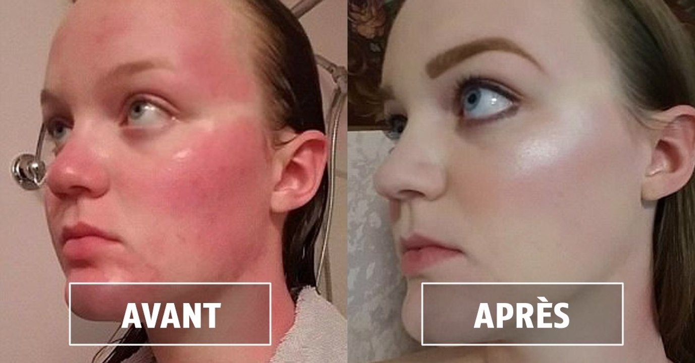 Beauté : l'avant/après du coup de soleil de cette jeune femme enflamme le web