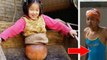 Qian Hongyan : amputée des jambes, elle se déplaçait à l'aide d'un ballon de basket... elle est aujourd'hui championne olympique !