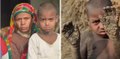Bangladesh: ce petit garçon est en train de se transformer en caillou, sa terrible maladie le contraint à être le paria du village