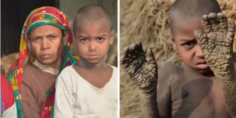Bangladesh: ce petit garçon est en train de se transformer en caillou, sa terrible maladie le contraint à être le paria du village