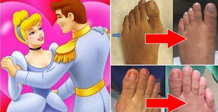 Chirurgie Cendrillon: ces femmes aux Etats-Unis se font raccourcir les pieds pour porter des escarpins...