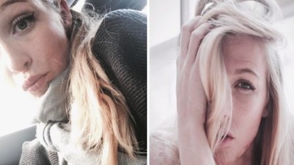 Cette jeune femme brûle 40% de son corps à cause d'un accident