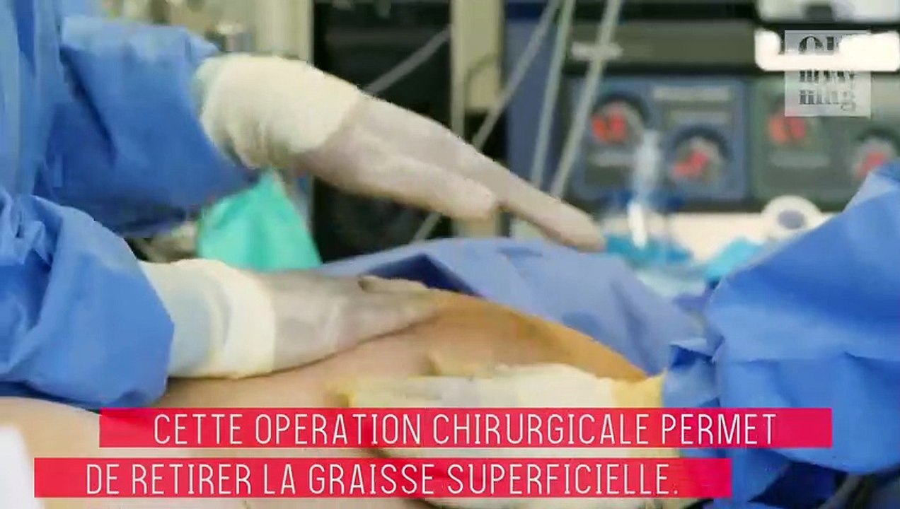 Liposuccion : ventre, hanches, cuisses, fesses, tout ce qu'il faut savoir