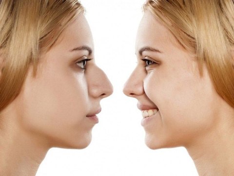 Rhinoplastie : prix, douleur, résultats, tout savoir sur la chirurgie du nez