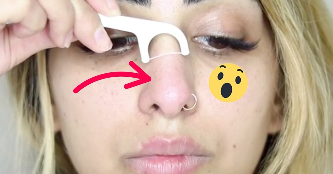 Points noirs : l'astuce stupide et dangereuse pour supprimer vos points noirs !