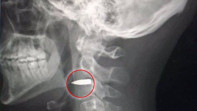 Atteint d'une balle dans le cou, il survit miraculeusement