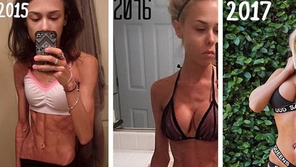 Annalise Mishler : cette ancienne anorexique est devenue magnifique