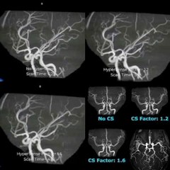 mri brain angiography