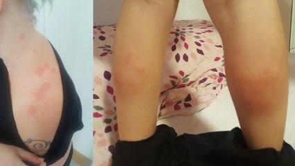 Elle regarde la jambe de sa fille et découvre le pire cauchemar de tout voyageur