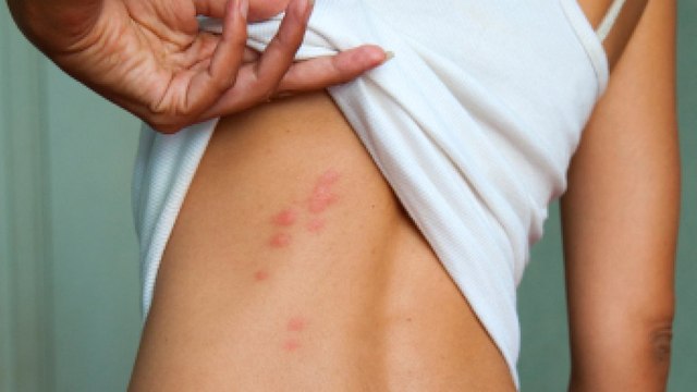 Piqûre de moustique : tous les remèdes de grand-mère