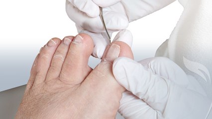 Ongle incarné au pied : que faire pour le soigner ?