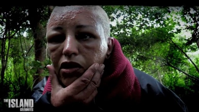 The Island Célébrités : Lââm en larmes quand elle aperçoit son visage défiguré
