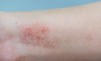 Eczema: Symptoms,Treatments, And Causes