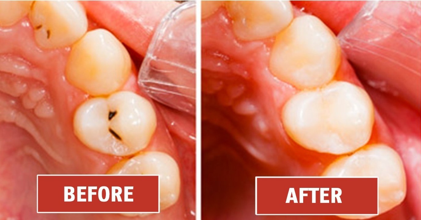 According To Scientists This Sugar Substitute Could Beat Cavities