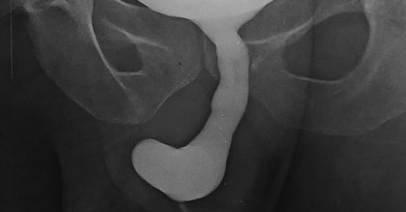 This Man's Penis FELL OFF After He Contracted Gangrene