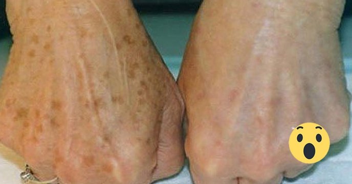 These Two Natural Ingredients Are All You Need To Get Rid Of Age Spots