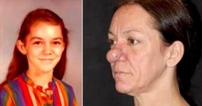 This Woman's Nose Had Not Stopped Growing For Almost 50 Years, Today She Looks Totally Different