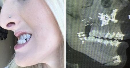 She Was Bullied Because Of Her Jaw As A Kid But Now She’s Absolutely Stunning