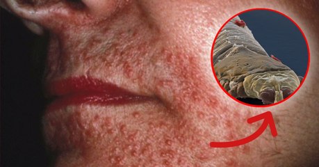 This is the creepy insect that lives on everyones' face