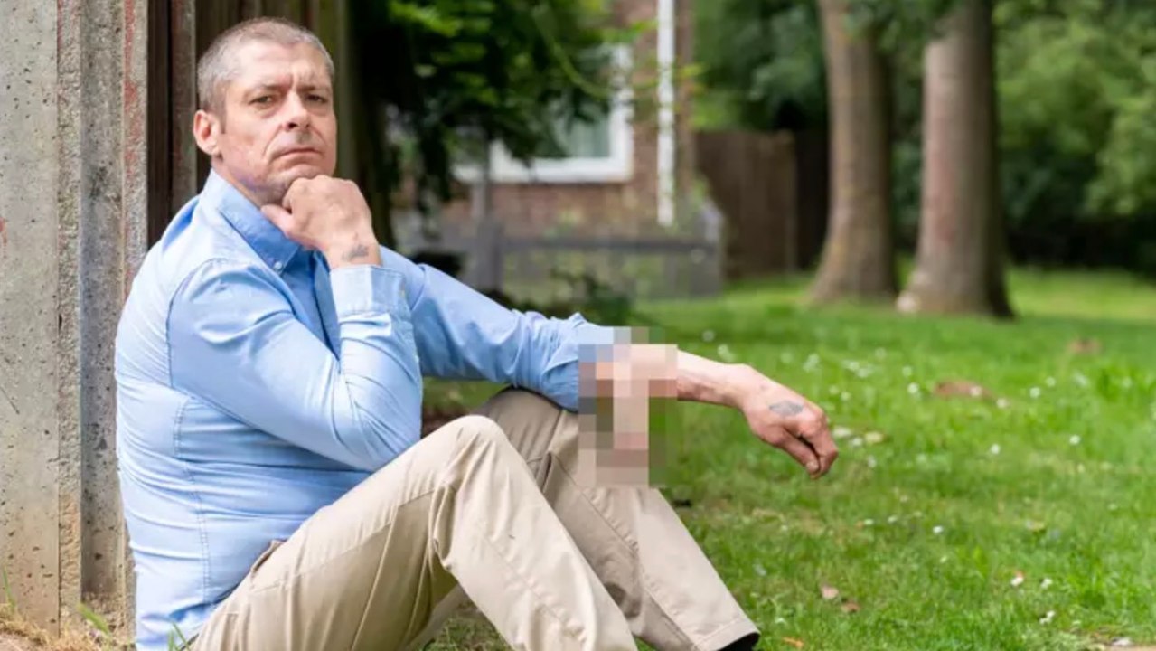 Man loses genital after infection and gets 'bionic penis' graft on his arm