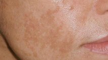 4 Bad Habits That Lead To Those Brown Spots On Your Skin