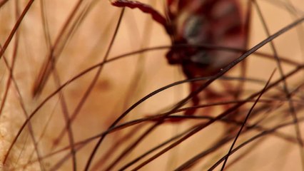 Tick bite: Alarming symptoms and what to do if you've been bitten