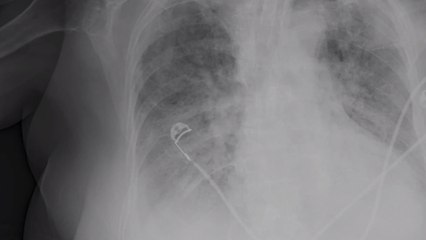 CAT scans reveal COVID damage on people lungs