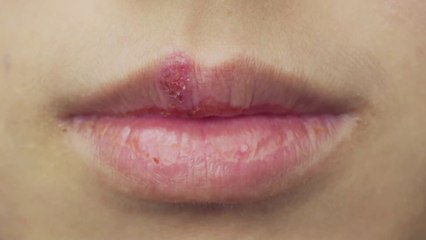 Decoding herpes: Telltale sign that you've been infected