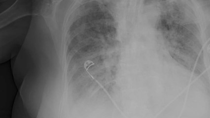 This is how COVID-19 can inflict long-term lung damage