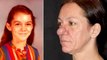 This Woman's Nose Has Been Growing Since She Was 15 Years Old, Find Out What She Looks Like Now!