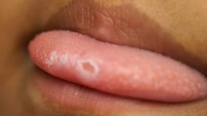 Woman’s tongue starts to grow hair