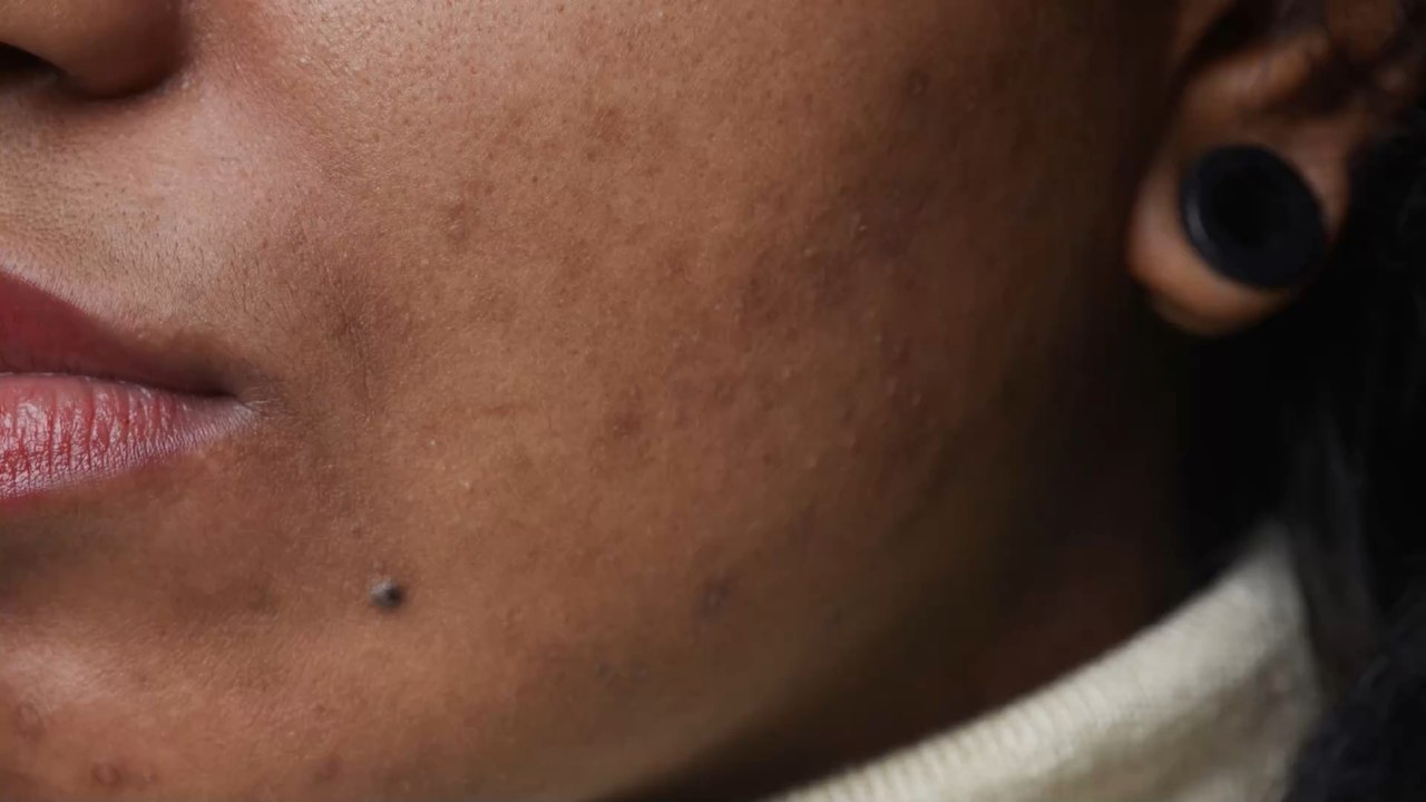 How to eliminate post-inflammatory hyperpigmentation