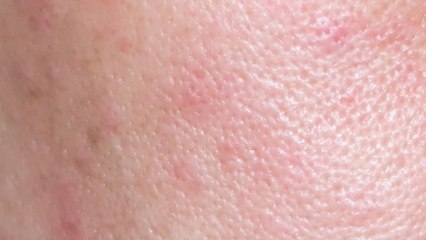 Post-Inflammatory Erythema: Causes, Symptoms & Effective Treatments ✨