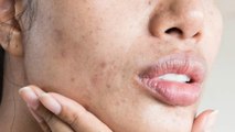 10 OTC skincare ingredients to treat acne