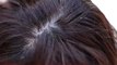 Dandruff: Here's what your flakes say about your scalp condition