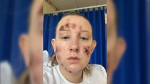 Teenager’s face ravaged by rare flesh-eating ulcers