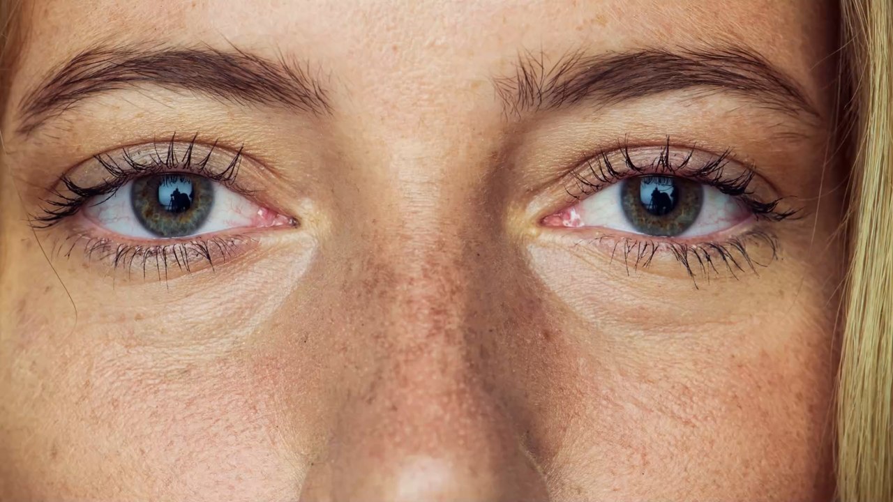 Can Accutane really give you a ‘free nose job?' video Dailymotion