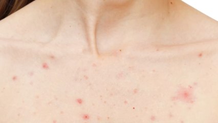 Chest acne: Why we get it and how to get rid of it