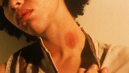 Six ways to get rid of a hickey that actually work — and two that don't
