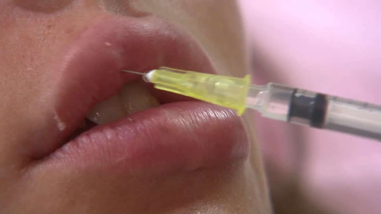 Woman’s infected filler explodes, covering doctor in pus