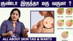 வலியே இல்லாமல் மருவை நிரந்தரமாக நீக்கலாம்! | Warts Vs Skin Tags | Dr Shwetha Rahul Explains