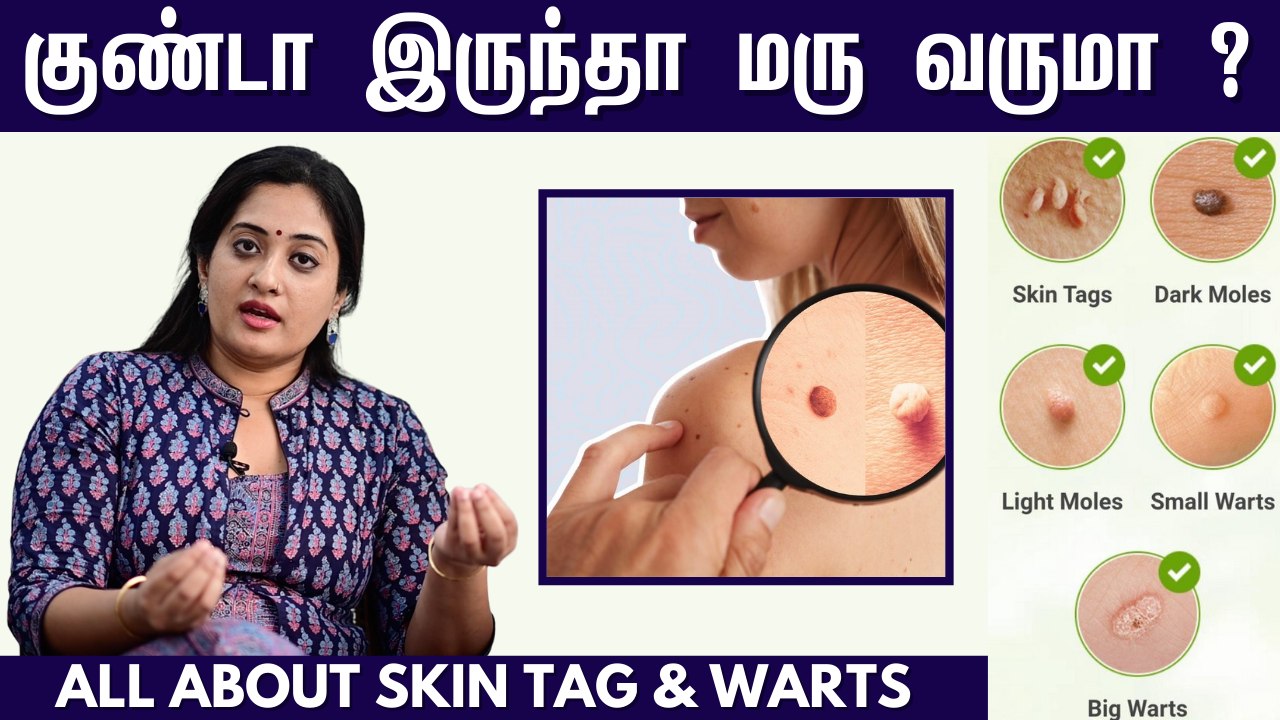 வலியே இல்லாமல் மருவை நிரந்தரமாக நீக்கலாம்! | Warts Vs Skin Tags | Dr Shwetha Rahul Explains