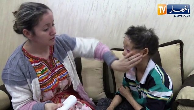 تيزي وزو: حسين رمضاني.. طفل في التاسعة من العمر يعاني من مرض السمك الجلدي