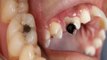 दांतों में सड़न कारण । दांतों में सड़न लक्षण और उपाय । Boldsky